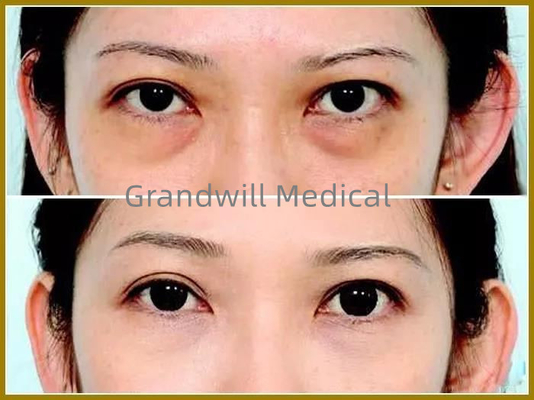 Hyaluronic кисловочные заполнители ухода за лицом дермальные для заполняя круга глаза ринва разрыва