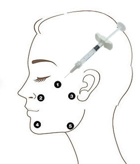 Заполнитель Profhilo H+L 32mg OEM не соединенный крестом Hyaluronic кисловочный 5 пунктов впрыски
