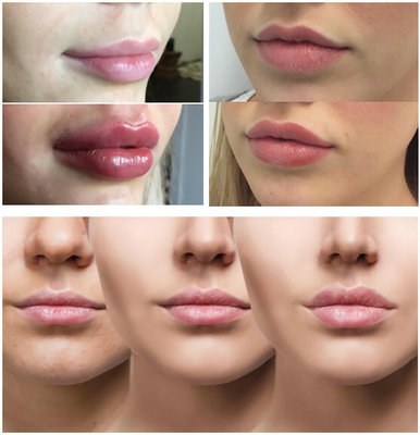 Ровные линии/пухлые губы с Hyaluronic кисловочным вводимым заполнителем 1ml 2ml 5ml