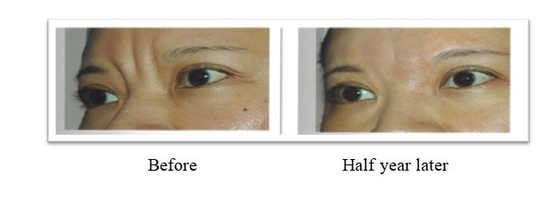 350 мг 150 мг ПЛЛА Поли L молочная кислота Dermal Filler для лечения морщин лица