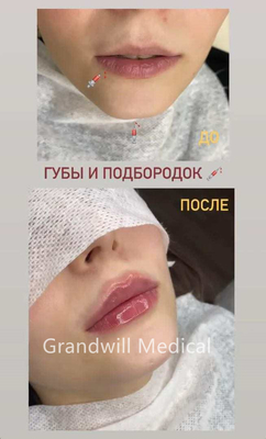 24 мг/ мл Инъекционное гиалуроновое кислотное кожное наполнитель для сглаживания морщин