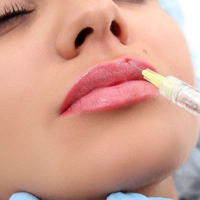 Заполнители геля лицевого дермального натрия впрыски Hyaluronic кисловочные наблюдают морщинка