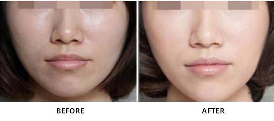 Не перекрестная соединенная впрыска Hyaluronate натрия Rejuvenating для заботы кожи