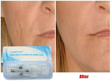 Hyaluronic кисловочный вводимый заполнитель 10ml для увеличения Chin щек впрыски губы