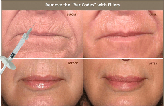 вводимый Hyaluronic кисловочный дермальный заполнитель 10ml для исправлять лицевую асимметрию