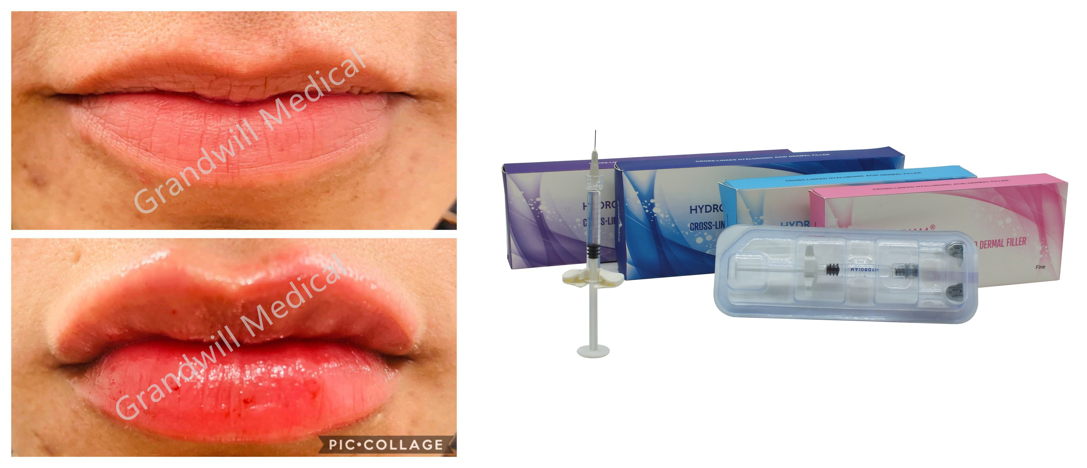 Перекрестный соединенный заполнитель впрыски натрия Hyaluronic кисловочный дермальный для морщинок наполненности губы лицевых