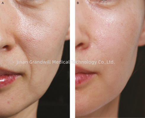 Miracle H L PCL Skin Booster Финолинейный поликапролактон гиалуроновой кислоты для инъекций
